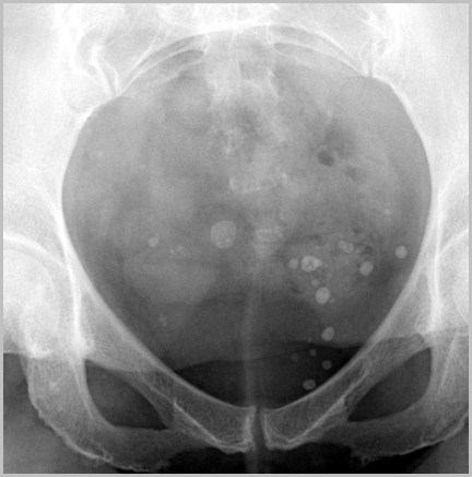 calcifications tissue soft